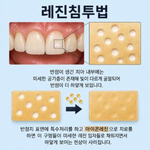 아이콘 레진