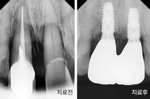 앞니, 임플란트
