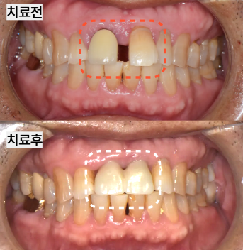 흔들리던 앞니, 가이드임플란트 치료 사례-동문동치과