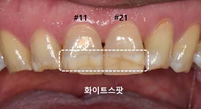 얼룩덜룩한 앞니 화이트스팟,아이콘 레진 치료 사례