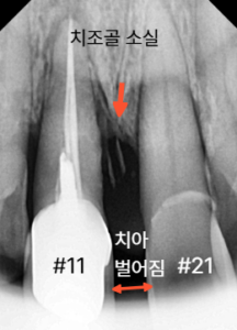 앞니, 임플란트