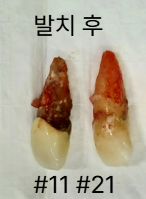 앞니, 임플란트