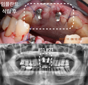 앞니, 임플란트