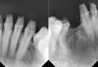 서산연세치과 아래 앞니 기존 보철 제거 후 방사선사진, lower anterior crown removal