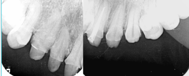 서산연세치과 위 앞니 기존 보철 제거 후 안쪽 치아를 확인한 방사선사진, upper anterior crown removal