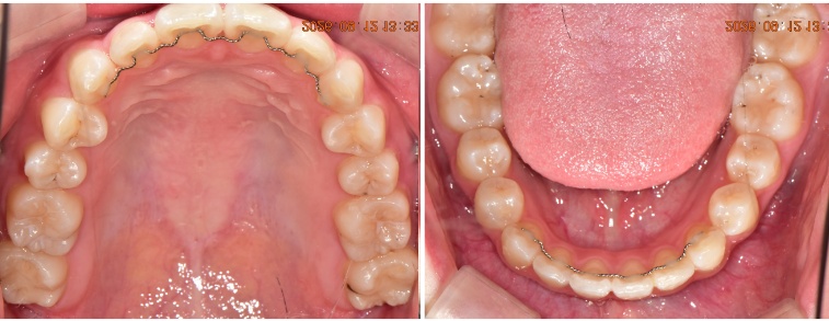 서산연세치과 성장기 교정 전체교정 후 구강사진, after occlusal