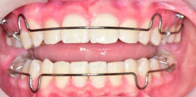 서산연세치과 성장기 교정 치료 후 유지장치, after retainer
