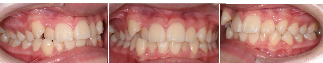 서산연세치과 성장기 교정 치료 전 구강사진, before intraoral