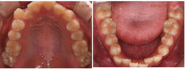 서산연세치과 성장기 교정 치료 전 구강사진, before occlusal