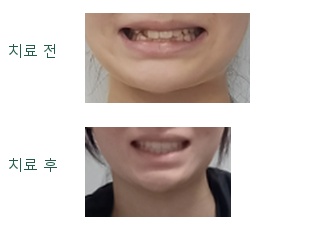 서산연세치과 성장기 교정 정면 미소 비교, front smile before after