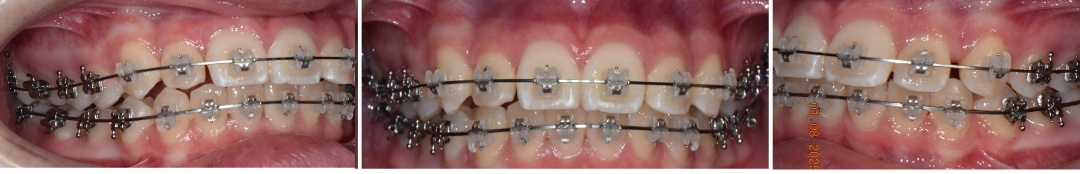 서산연세치과 성장기 교정 교정 진행 중 구강사진, progress braces
