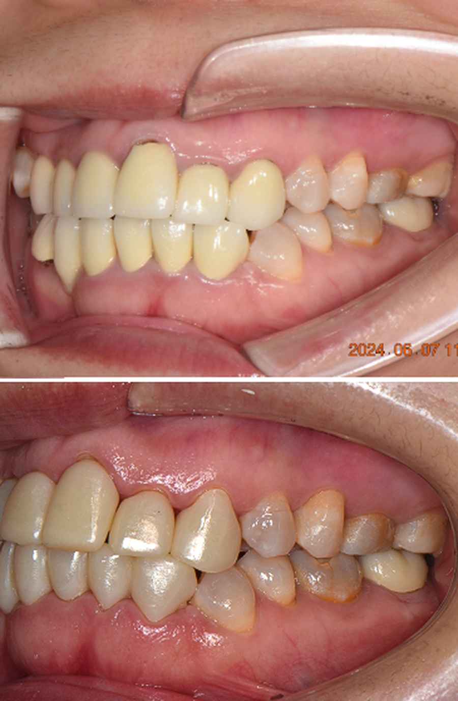 서산연세치과 앞니 보철 교체 왼쪽 측면 비교, 위는 치료 전 아래는 치료 후, zirconia crown left before and after